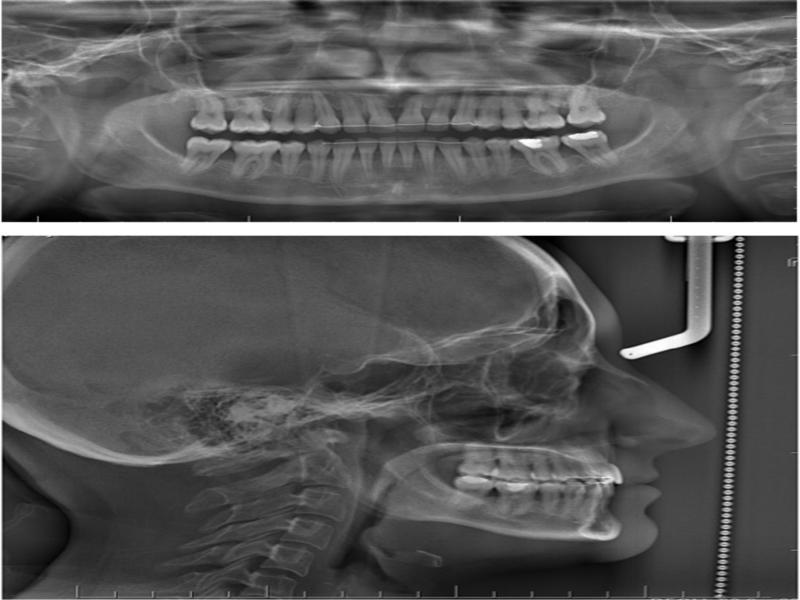 Panoramic X-ray and lateral cephalogram at 2-year follow-up.