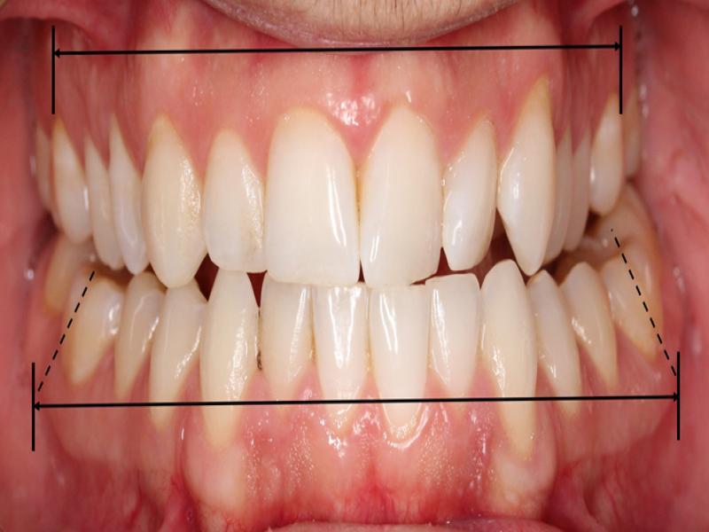 Transverse discrepancy observed in a patient who was diagnosed of maxillary deficiency and required maxillary skeletal expansion. Maxillary basal arch width was significantly smaller than the lower basal arch width. Dental compensation was often observed in the lower molars.