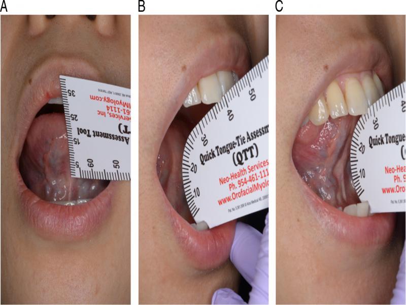 A numerical assessment of the tongue tie and restriction of tongue mobility. (A) Kotlow free tongue measurement, (B) Maximal interincisal mouth opening distance (MIO), (C) Mouth opening distance with elevating tongue-tip up to the maxillary incisive papillae (MOTTIP).