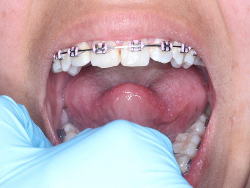 A clinical assessment of posterior tongue tie. The patients with posterior tongue tie showed cupping of the tongue during attempted elevation when the bottom of the tongue was being held down by the examiner.