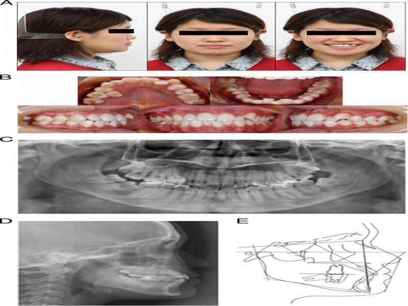 Pretreatment photographs and radiographs: (A) facial photographs, (B) intraoral photographs, (C) panoramic radiograph, (D) lateral cephalometric radiograph and (E) lateral cephalometric tracing.