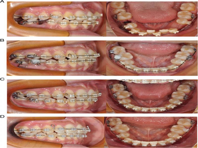 Progress photographs: (A) mesial movement of the mandibular right first molar, (B) mesial marginal ridge of the mandibular right second molar is confirmed, (C) initial stage of molar occlusion using the occlusal surface of the mandibular right second molar, (D) inclination of the second molar is improved.