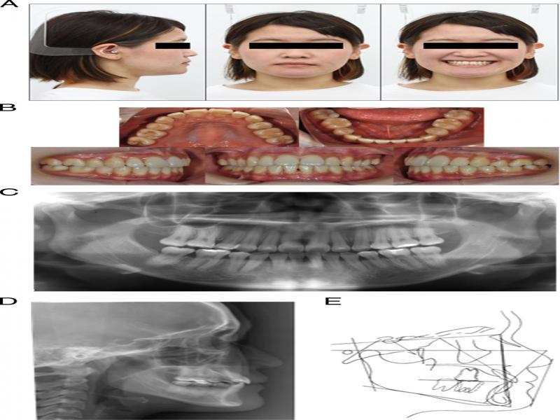 Posttreatment photographs and radiographs: (A) facial photographs, (B) intraoral photographs, (C) panoramic radiograph, (D) lateral cephalometric radiograph and (E) lateral cephalometric tracing.