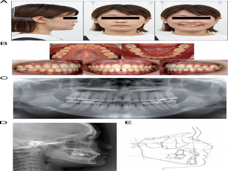 After retention photographs and radiographs: (A) facial photographs, (B) intraoral photographs, (C) panoramic radiograph, (D) lateral cephalometric radiograph and (E) lateral cephalometric tracing.