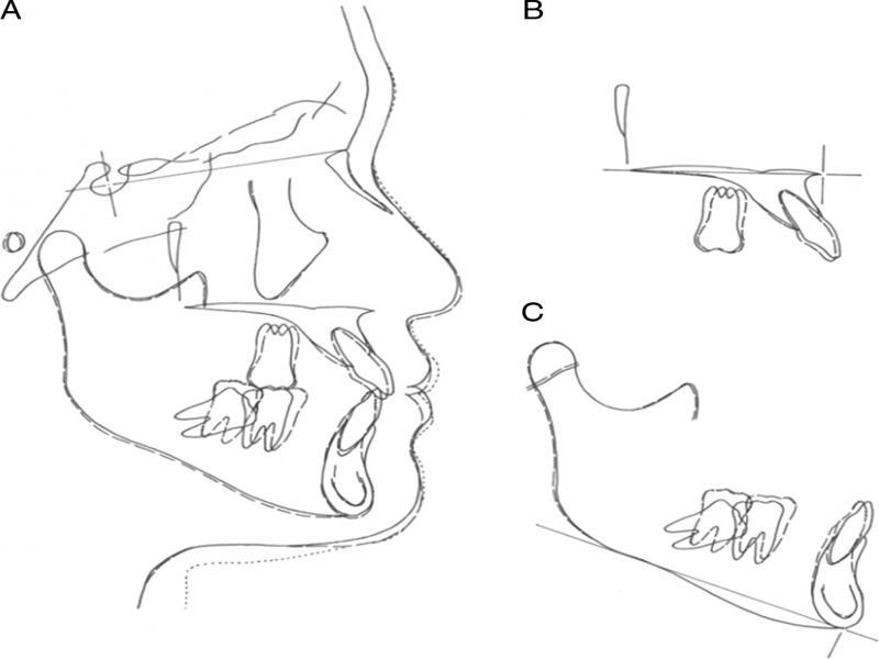 Superimposed tracings of lateral cephalometric radiographs at pretreatment (solid line), posttreatment (dashed line), and after retention (dotted line); right molars are traced. (A) on the sella-nasion plane at the sella, (B) on the palatal plane at ANS and (C) on the mandibular plane at Menton.