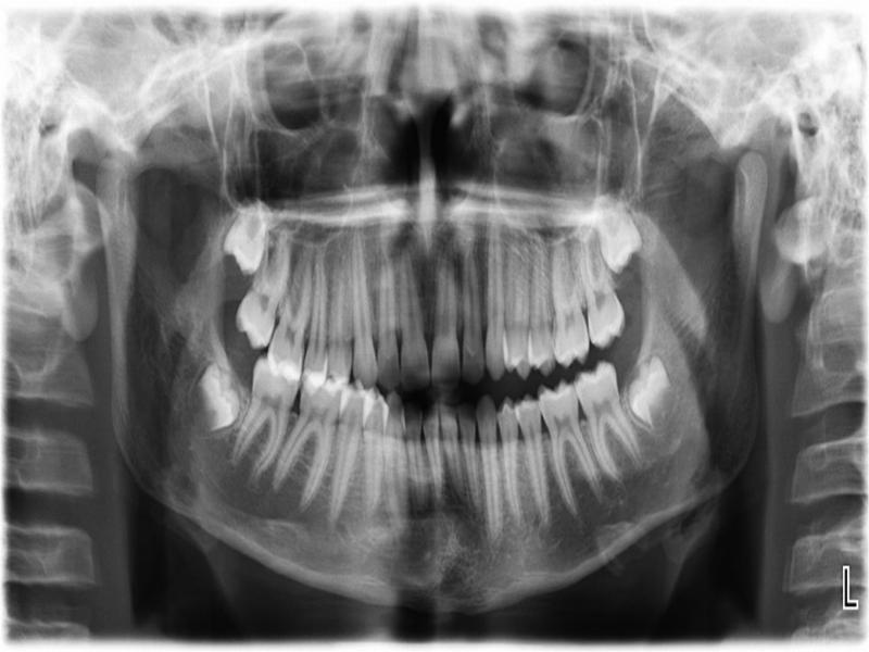 Pre-treatment panoramic radiograph.