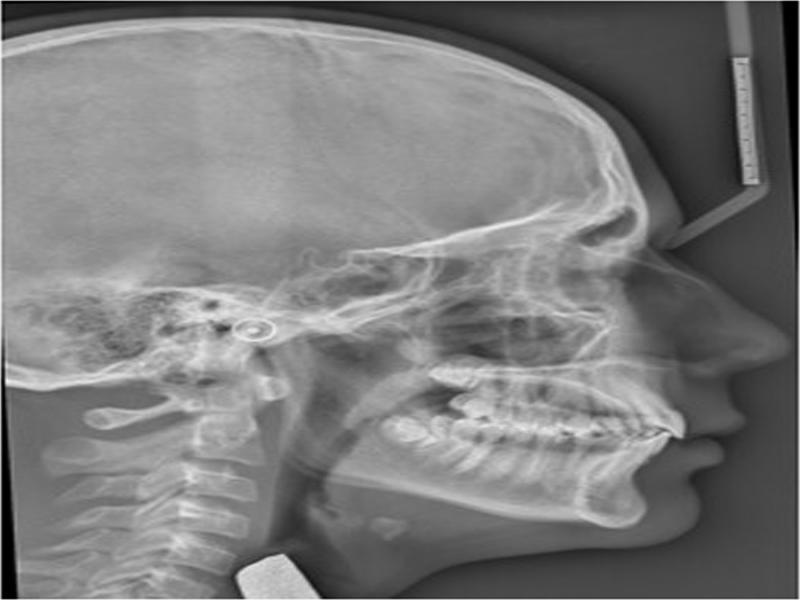 Pre-treatment lateral cephalograph.