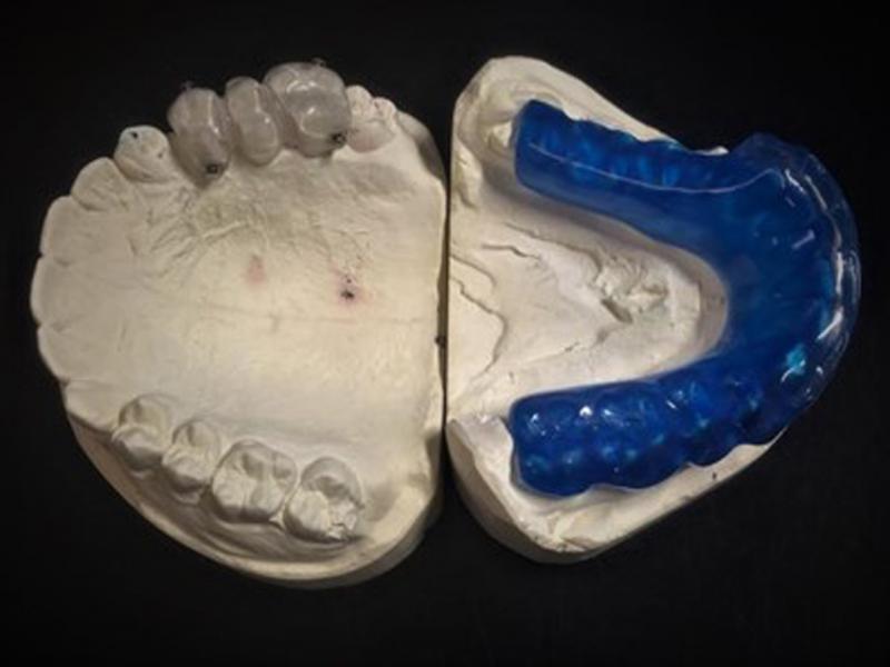 Working models with the upper bonded occlusal splint and lower removable bite plate.