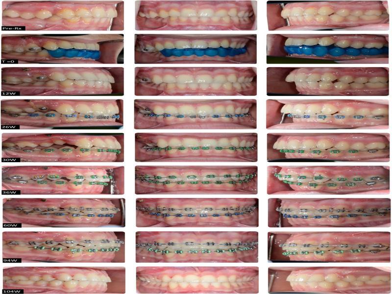 Treatment progression shown in frontal photographs (time-period in weeks).