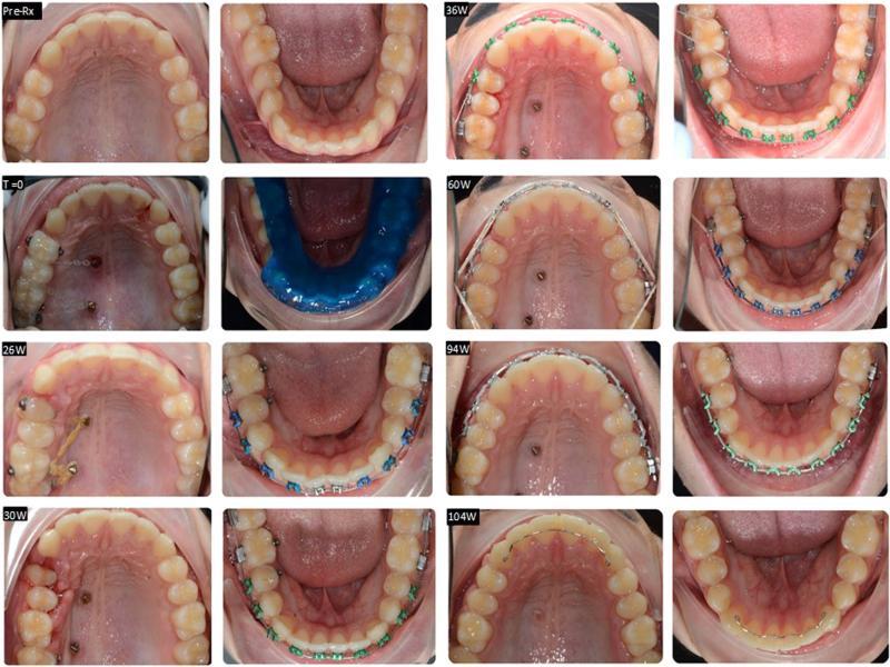 Treatment progression shown in occlusal photographs (time-period in weeks).