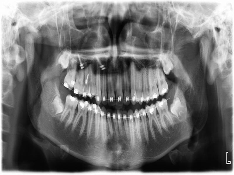 Post-treatment panoramic radiograph.