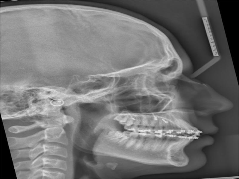 Post-treatment lateral cephalograph.
