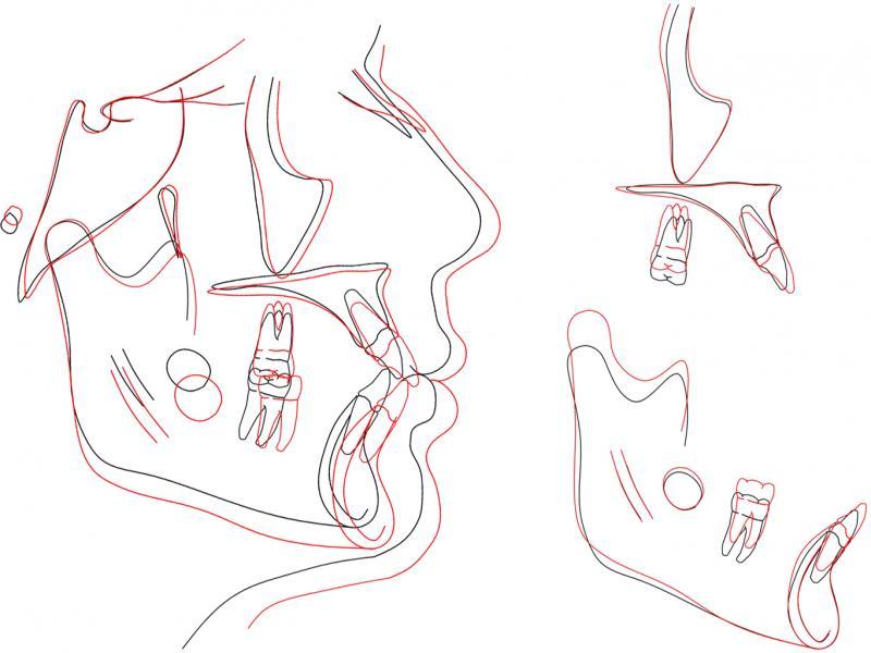 Superimpositions of pre-treatment cephalograph (Black) and post-treatment cephalograph (Red) over anterior cranial base (left) and anterior surface of maxilla (upper right) and stable structures of mandible (lower right) as per Bjork’s structural method.