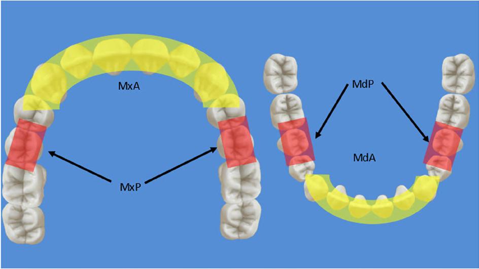 IPR Zones: MxA includes all contacts from the distal of the canines forward in the maxilla; MxP includes contacts mesial and distal of the premolars in the maxilla. MdA includes all contacts from the distal of the canines forward in the mandible; MdP includes contacts mesial and distal of the premolars in the mandible.