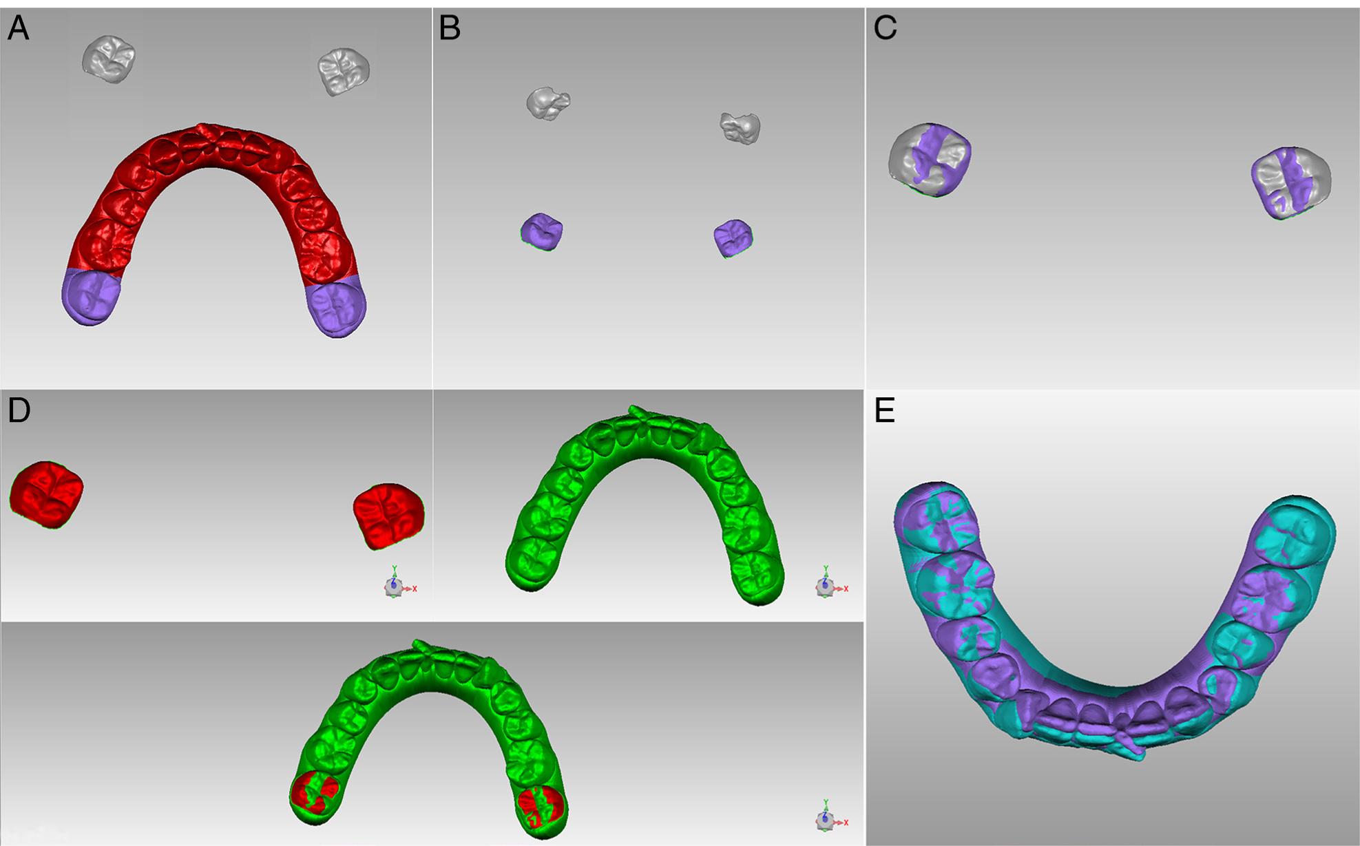 Superimposition of the initial models and progress models based on the stable structure method (unmoved teeth in the ClinCheck) using the GEOMAGIC studio software. (a) Teeth designed not to be moved in ClinCheck were respectively separated from initial models and progress models (grey and purple coloured the second molars); (b) and (c) Registration of the unmoved teeth (second molars); (d) and (e) Final superimposition using the unmoved teeth (second molars) as reference.