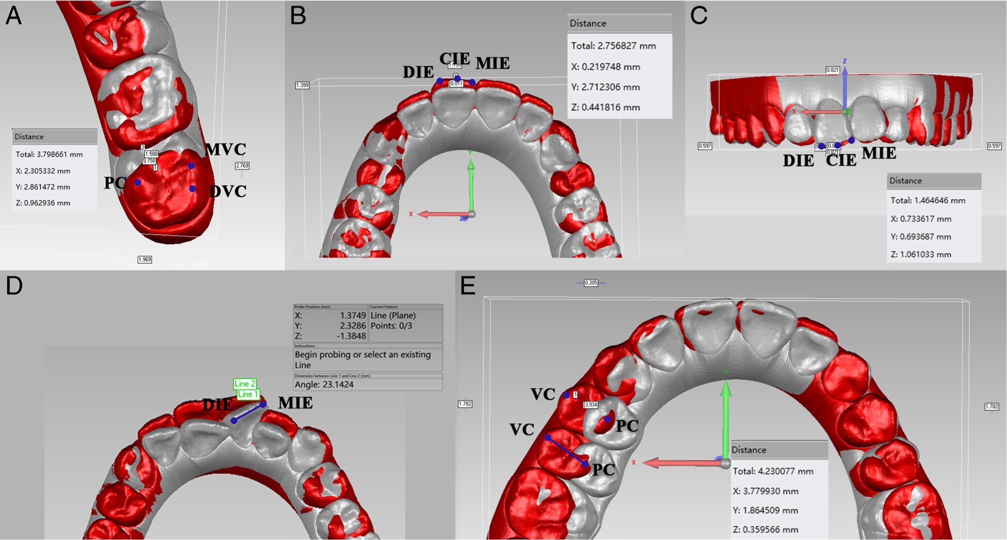 Measurement of OTM. (a) Molar distalization was measured at points of each cusp tip of molars; (b) Points of incisor edges were used to measure anterior retraction; (c) Measurement of anterior intrusion; (d) Lines of incisor edges were used to measure angle of anterior rotation; (e) Measurement of posterior expansion. CIE: central incisal edge; DIE: distal incisal edge; DVC: distal vestibular cusp tip; MVC: mesial vestibular cusp tip; MIE: mesial incisal edge; PC: palatal cusp tip; VC: vestibular cusp tip.