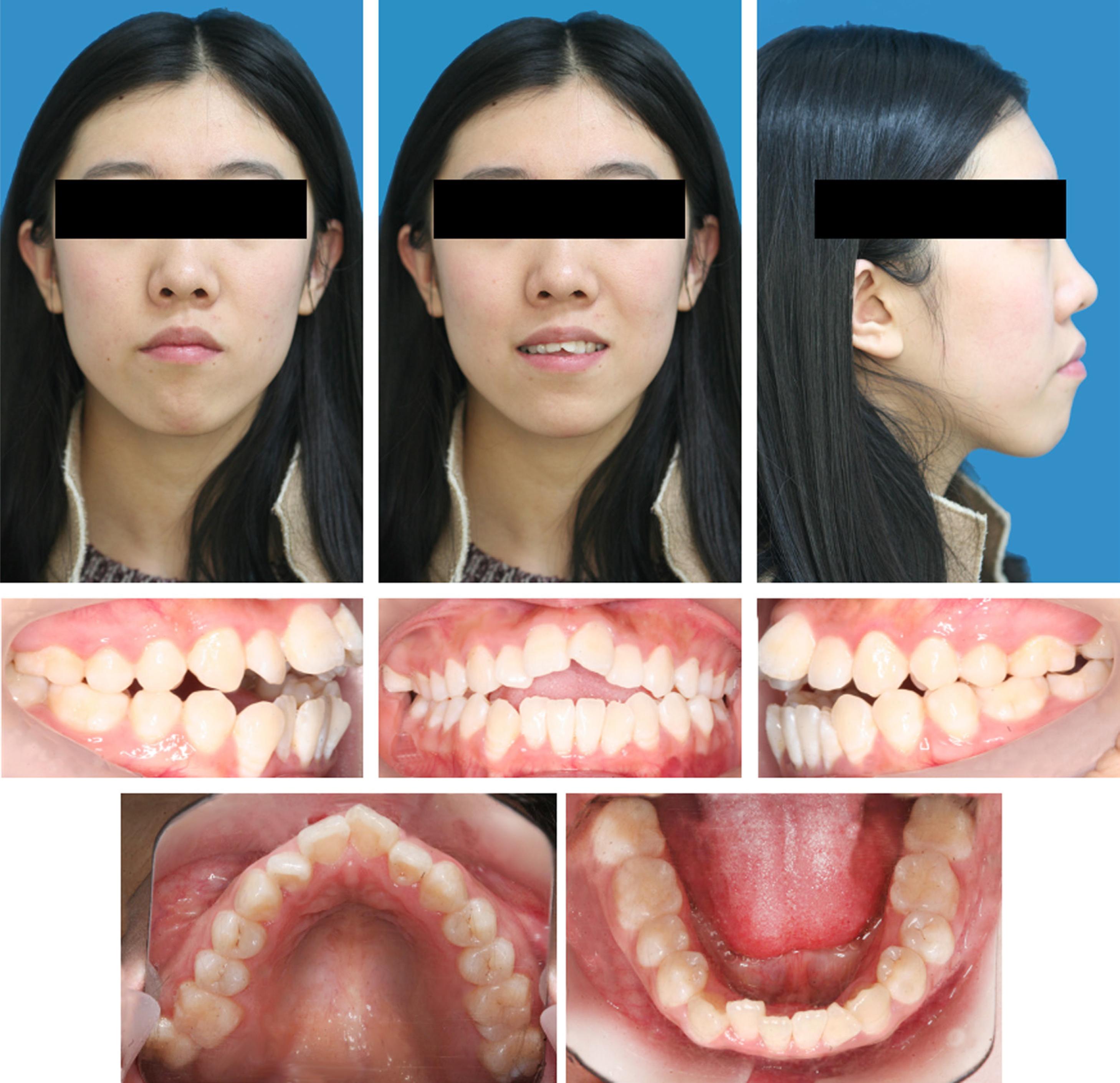 Pre-treatment extraoral and intraoral photographs.