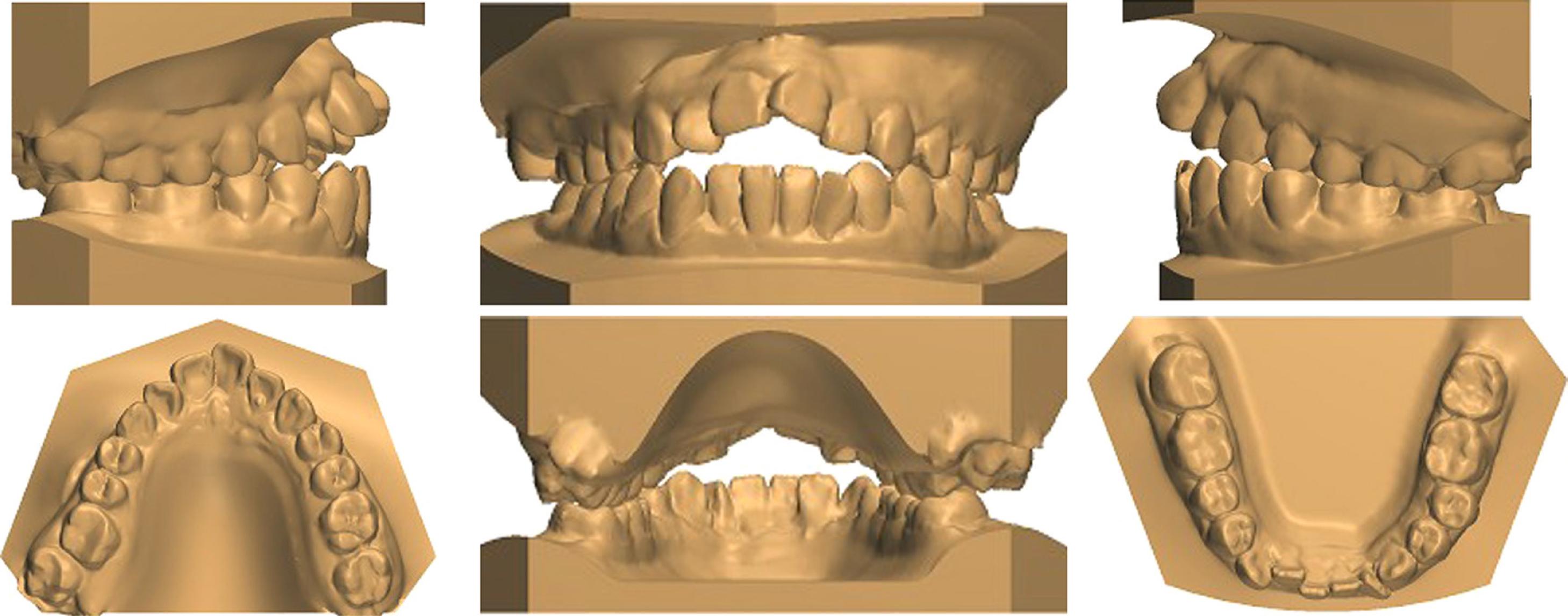 Initial study models.