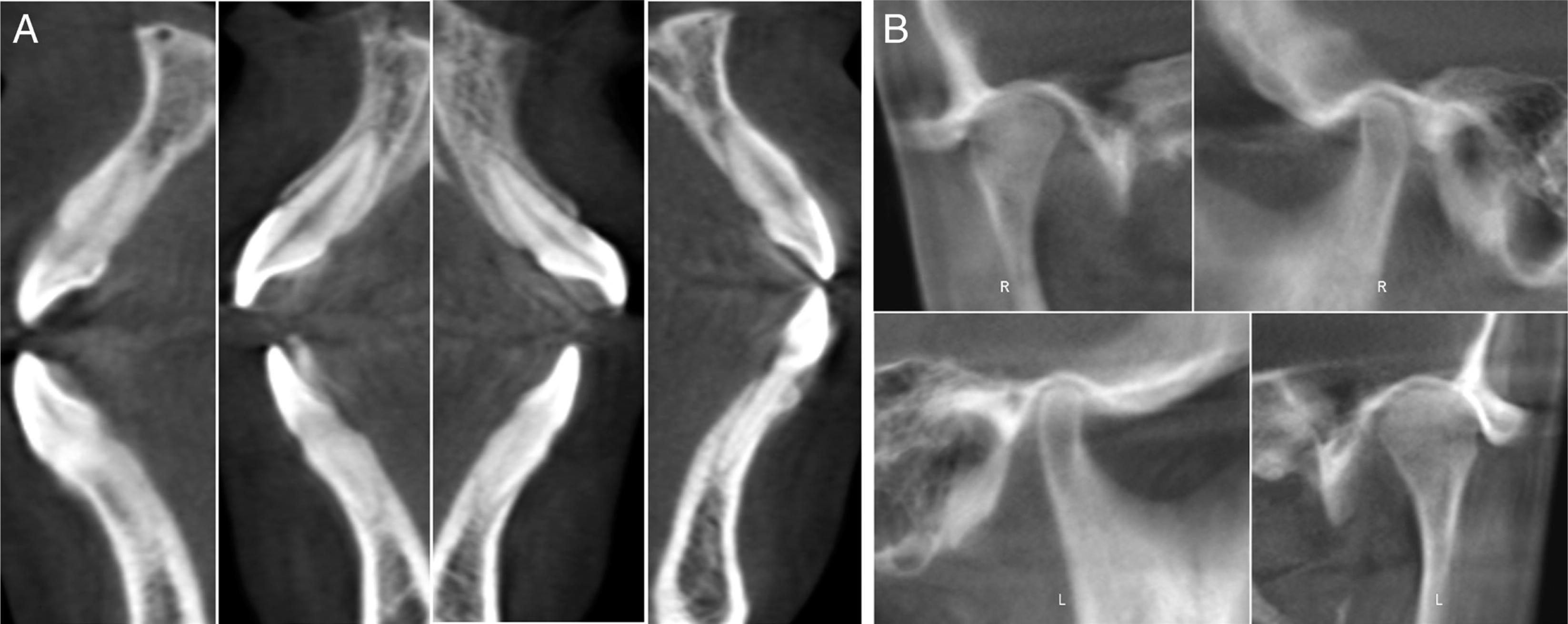 The pre-treatment labial and lingual bone volume of anterior teeth (A) and temporomandibular joint radiograph (B).