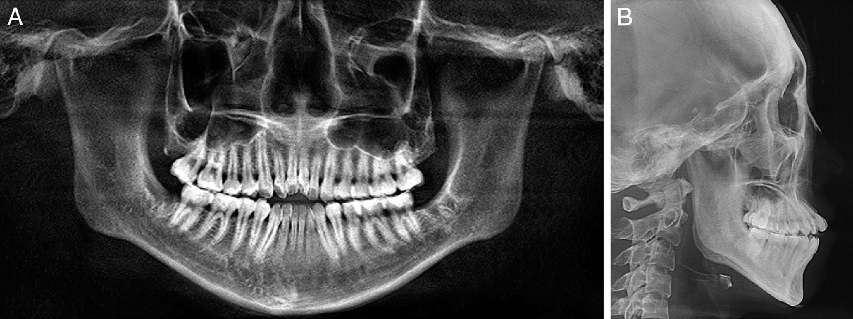 Pre-treatment panoramic radiograph (A) and lateral cephalometric radiograph (B).