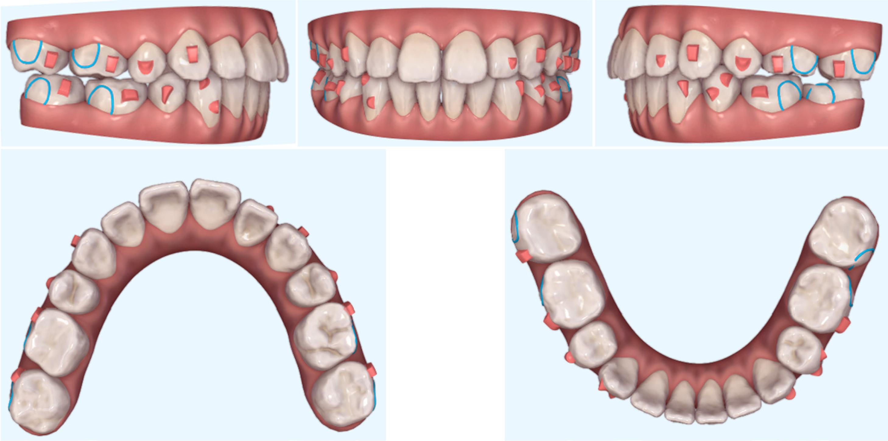 Refinement stage: ClinCheck treatment plan (Align Technology, Santa Clara, CA, USA).