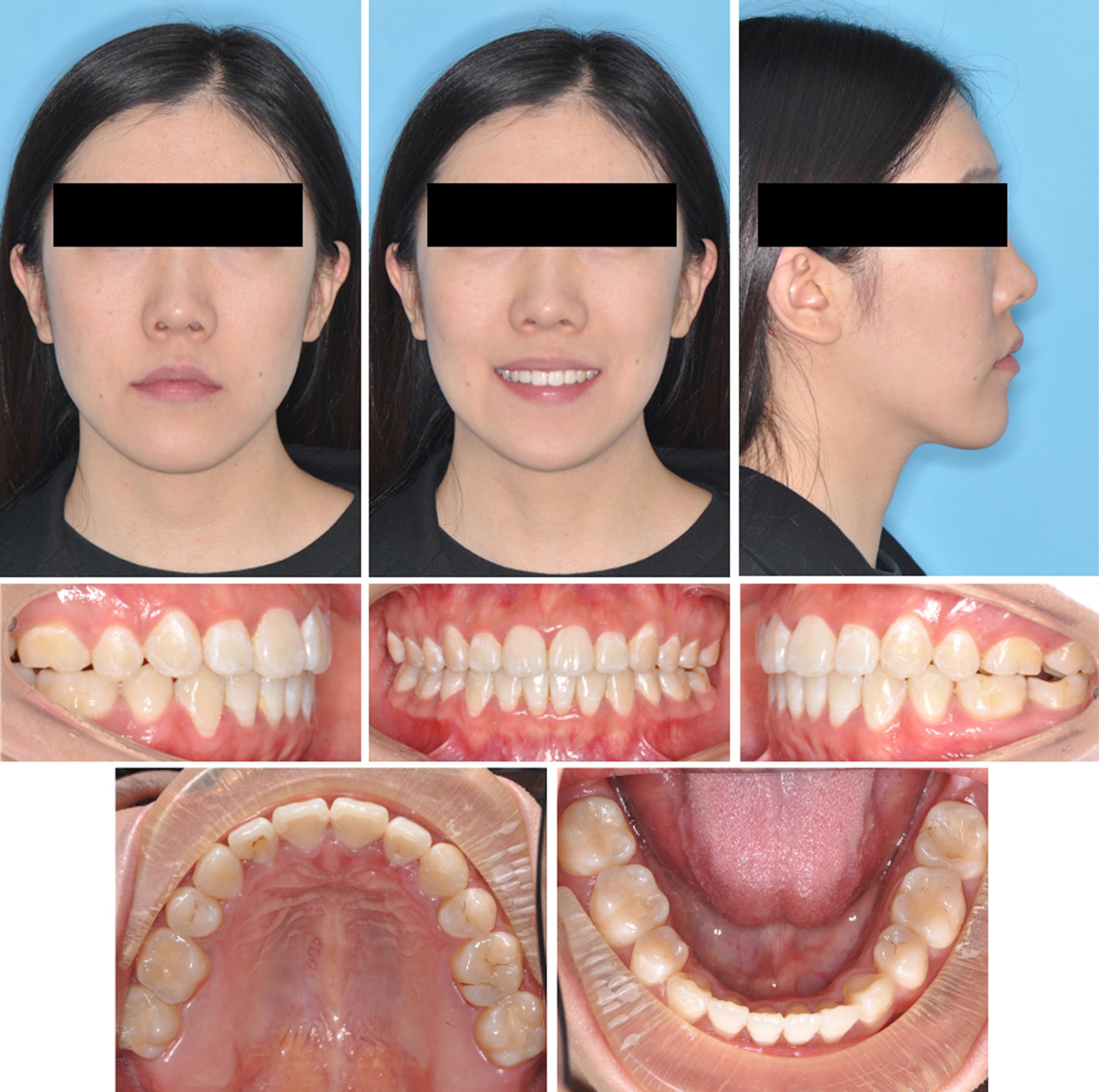 Post-treatment extraoral and intraoral photographs.