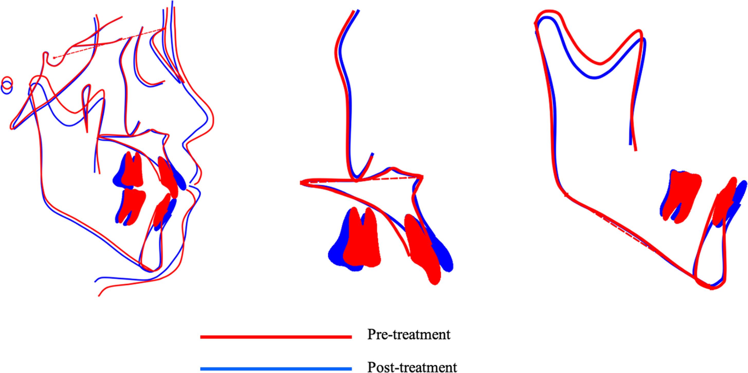 Two-dimensional (2D) superimposed cephalometric tracings.