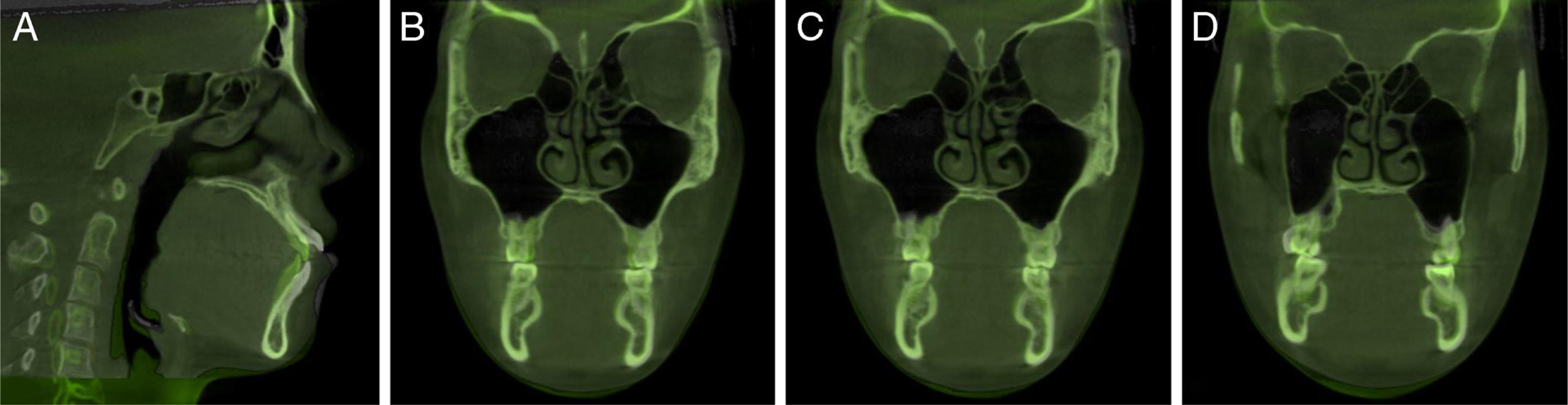 Three-dimensional (3D) superimpositions (pre-treatment and post-treatment). (A) the anterior teeth; (B–D) the posterior teeth.