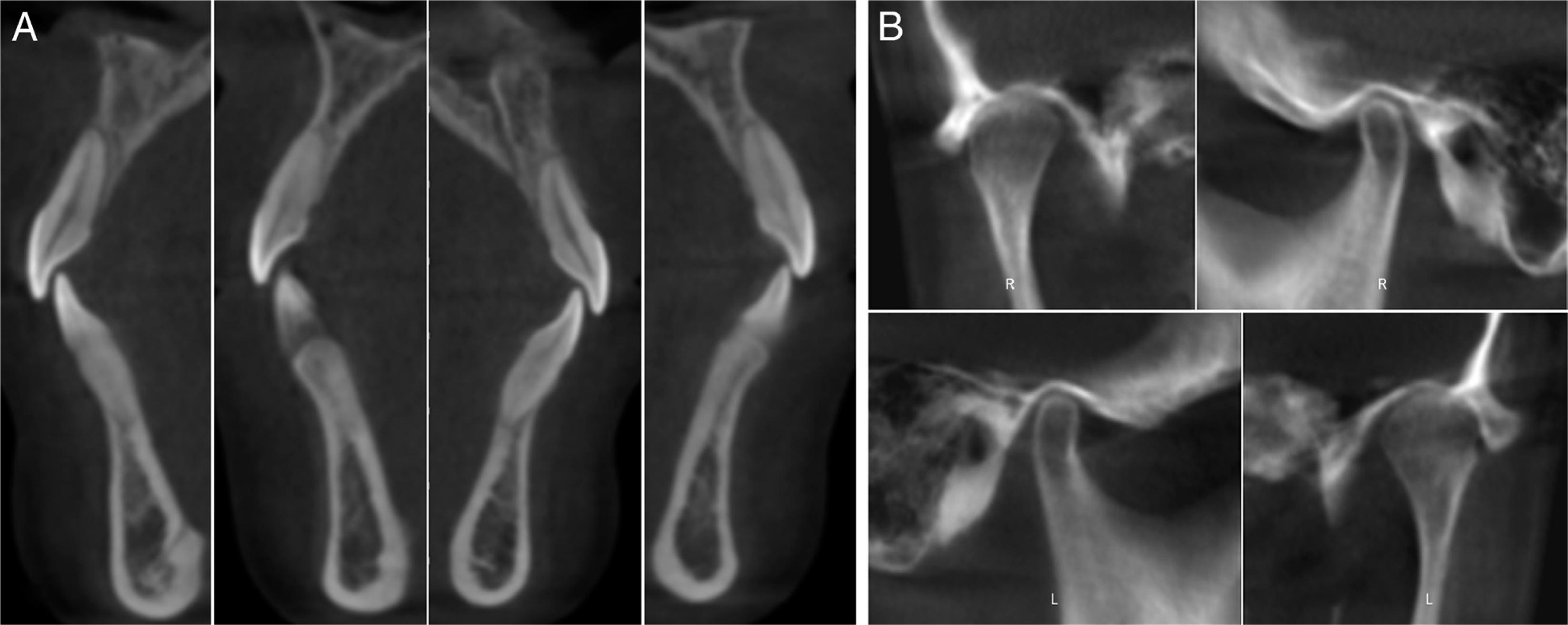 The post-treatment labial and lingual bone volume of anterior teeth (A) and temporomandibular joint radiograph (B).