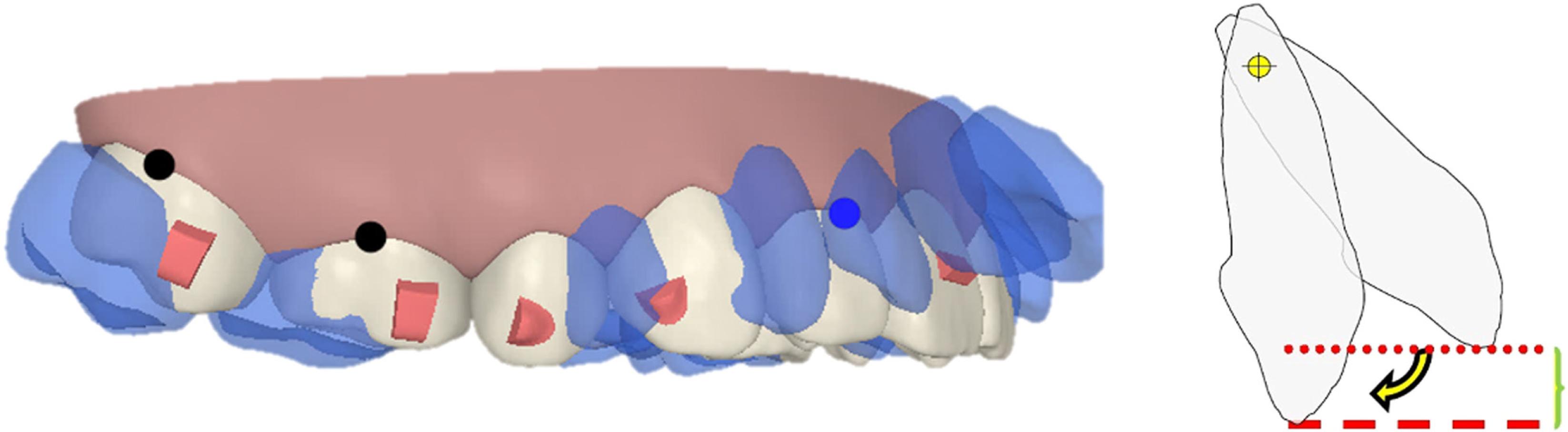 The ‘pendulum effect’ of the retraction of the anterior teeth.