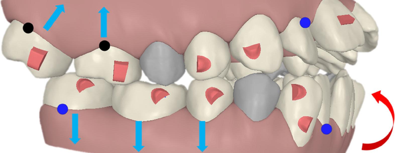 Counter-clockwise rotation of the mandible.