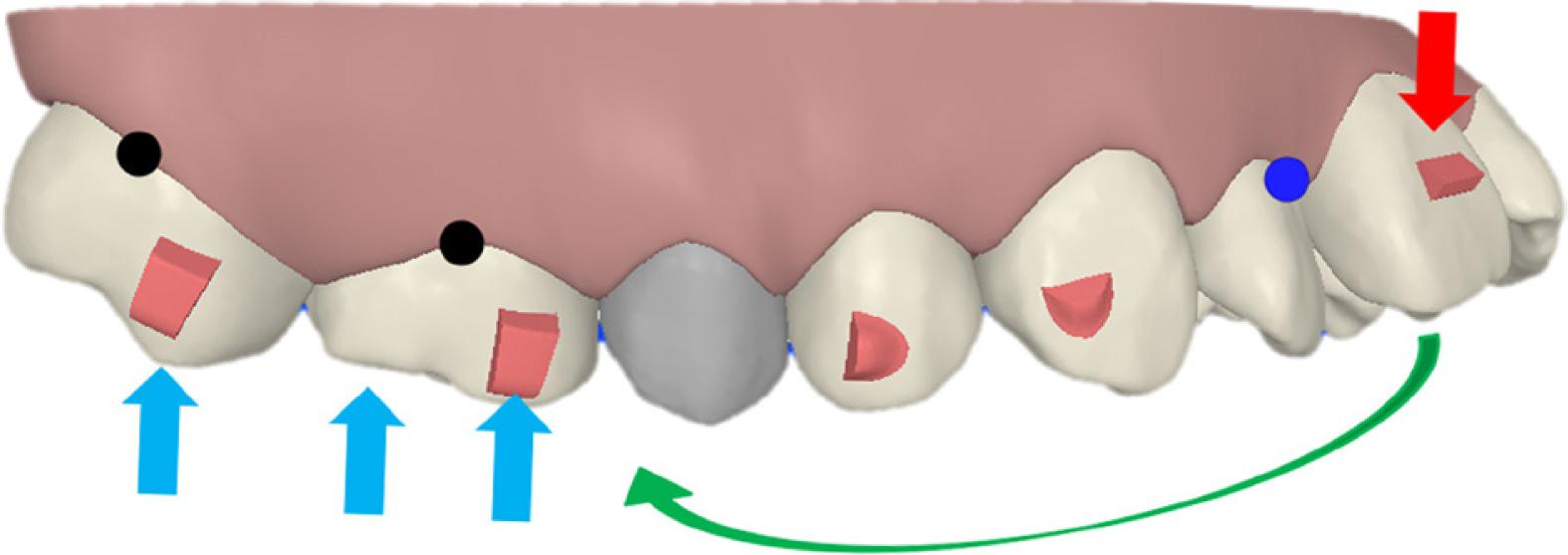 The extrusive force and intrusive force generated by reciprocal anchorage.