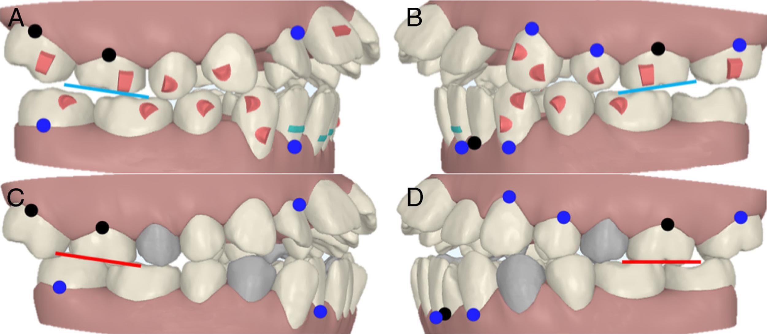 Overcorrection to keep the crowns inclined distally. (A-B) during treatment. (C-D) before treatment.