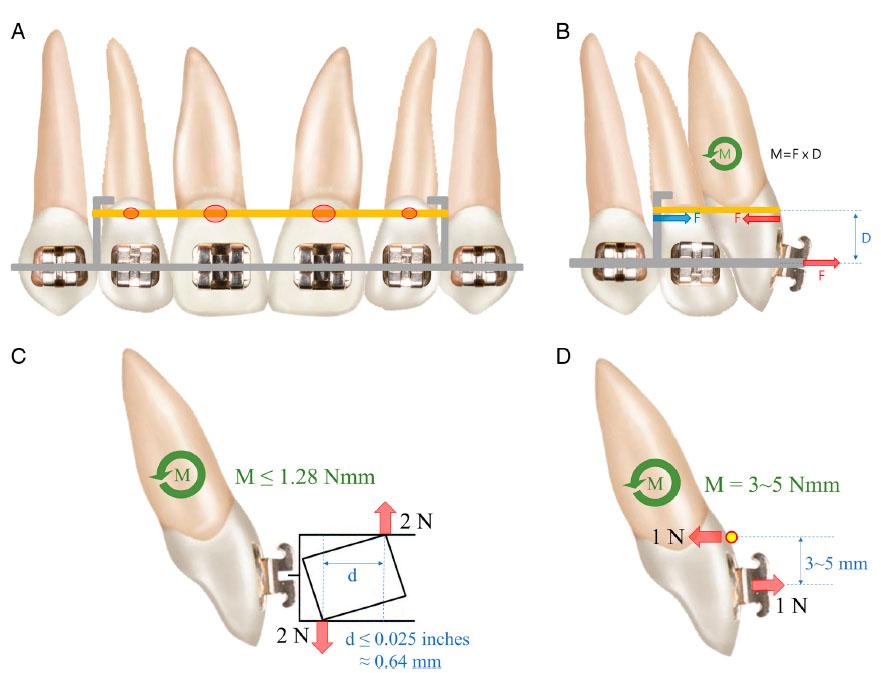The configuration of mechanics. (A) Frontal view. The red circles represent the tooth surface with which the thread is in contact. (B) Force diagram. The red arrows indicate the force vectors acting on the incisor, and the blue arrow denotes the force vector working on the archwire. The green circular arrow represents the couple force acting on the incisor. (C) Quantitative analysis of wire twisting technique. The red arrows denote orthodontic force generated from twisted wire. Due to the bracket play, the moment arm is less than the wire dimension. Despite high orthodontic force, the obtainable moment is rather limited. (D) Quantitative analysis of Park’s cervical torque tie. The red arrows demonstrate forces from the elastic thread. The moment arm is adjustable between 3 and 5 mm. With small orthodontic force, a large moment is obtainable.