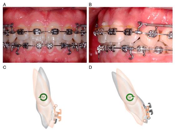 (A, B) The cervical torque tie’s intraoral view. The composite resins on the cervical area prevent the gingival damage which can be caused by the gingivally displaced thread. (C, D) Diagrams showing the couple force direction. The grey tooth indicates the initial position, and the orange tooth represents the latter position. Depending on whether the thread is on the cervical or incisal area, palatal or labial root moment can be obtained.