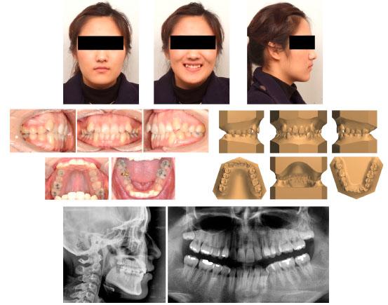 Pretreatment extra-, intraoral photographs, cephalogram, panoramic radiographs and 3-dimensional virtual model.