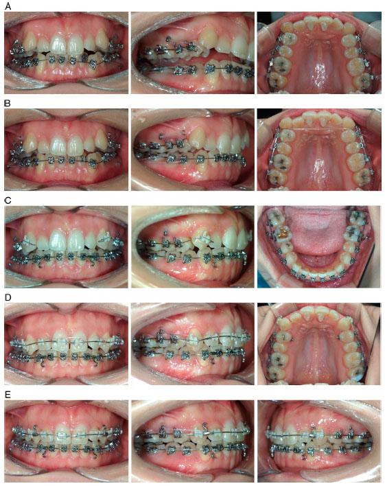 Treatment progress. (A) Initiation of treatment. (B) Three-month intraoral photograph. (C) 10-month intraoral photograph. (D) 16-month intraoral photograph. (E) 18-month intraoral photograph.