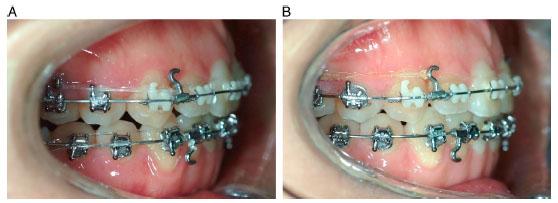 Change in the incisors’ inclination. (A) 18-month intraoral photograph. (B) 29-month intraoral photograph.