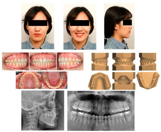 Post-treatment extra-, intraoral photographs, cephalogram, panoramic radiographs and three-dimensional virtual model.
