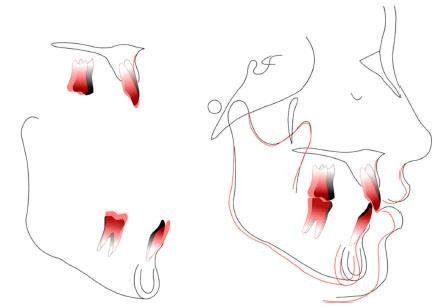 Cephalogram superimposition between pre- (black) and post-treatment (red).