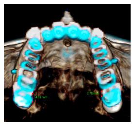 CBCT superimposition between pre- (white) and post-treatment (blue).