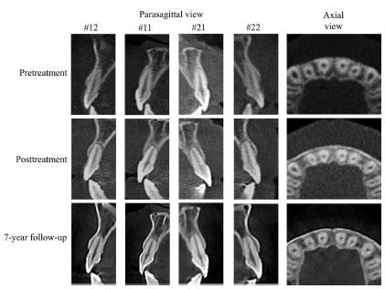 CBCT images’ sections at pretreatment, post-treatment and 7-year follow-up. The dehiscence on the palatal side, discovered after treatment, was recovered to the cortical bone 7 years later.