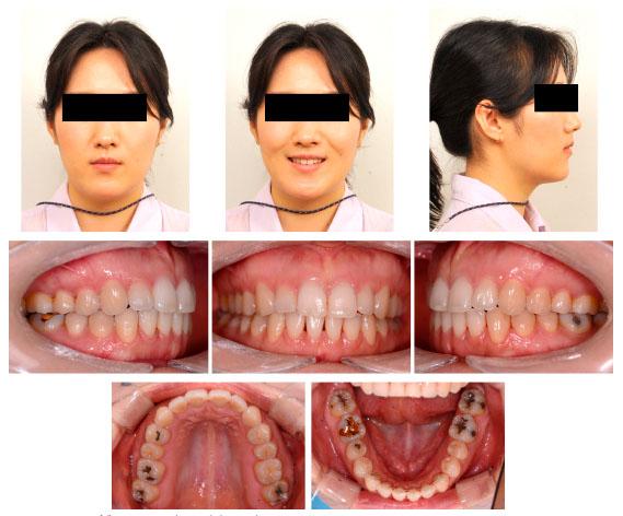 Seven-year follow-up extra- and intraoral photographs.