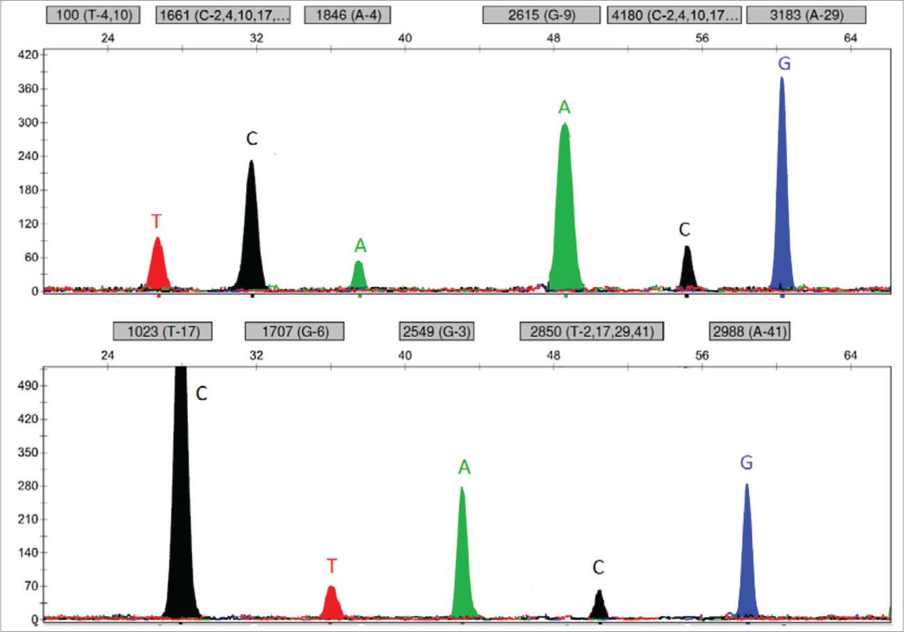 Representative electropherogram of homozygous patient with genotype *4/*4.