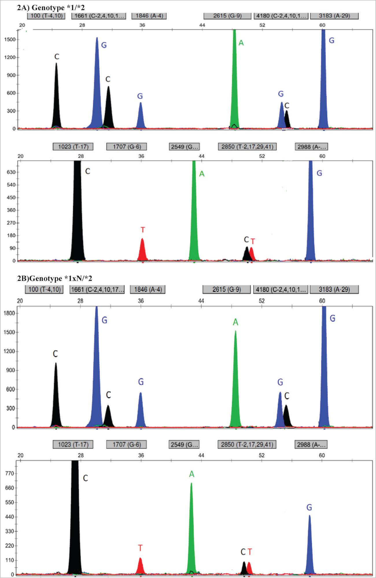 A) Representative electropherogram of a heterozygous patient without a duplication. B) Representative electropherogram of a heterozygous patient with a duplication.