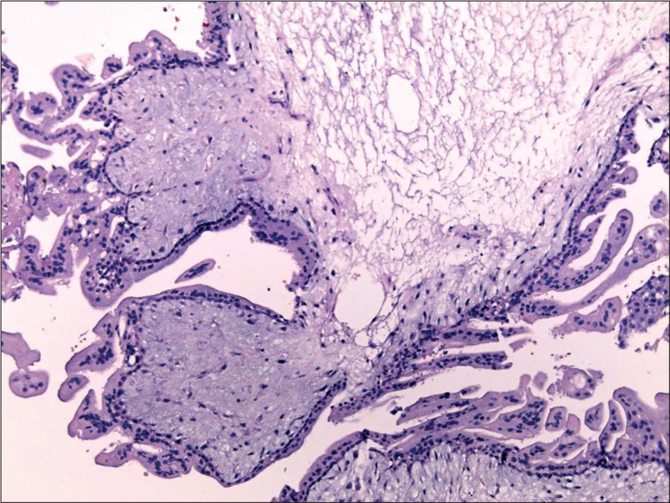 Microscopic appearance of the chorionic villi in complete hydatidiform mole with a pronounced stromal edema and trophoblastic proliferation (hematoxylin and eosin, ×100).