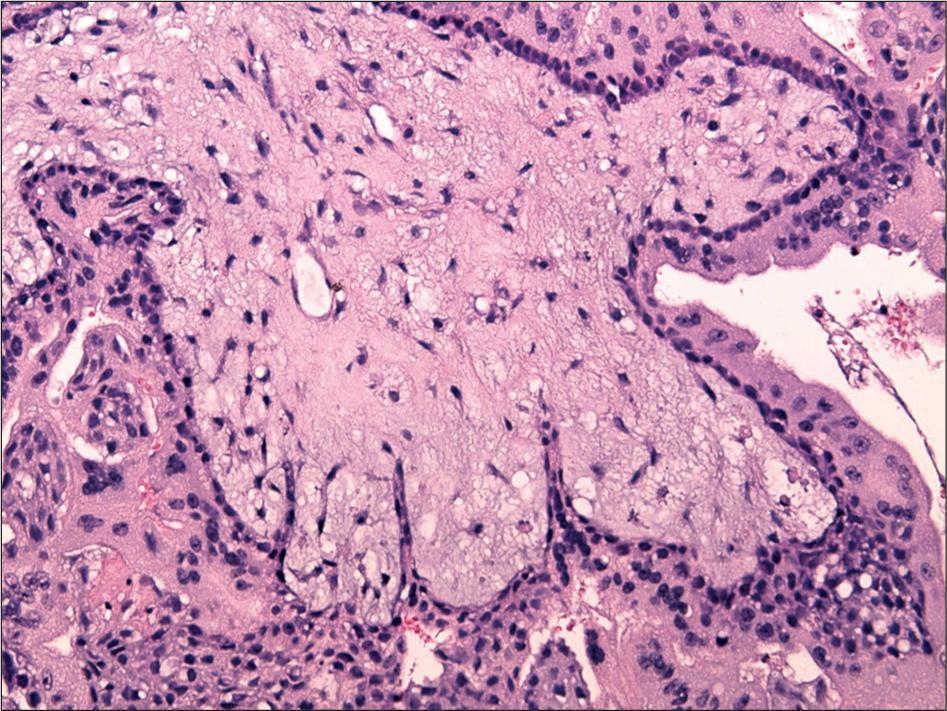 Mucoid stromal degeneration and irregular villous contours in complete hydatidiform mole (hematoxylin and eosin, ×200).