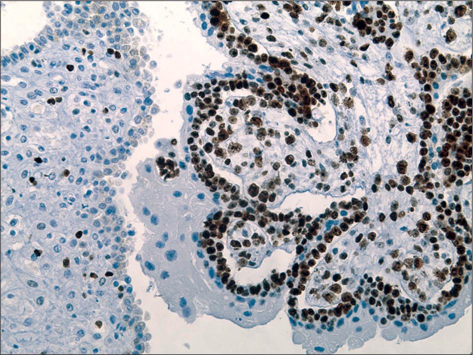 Ki-67 proliferation index >50.0% in villous cytotrophoblasts (×200).