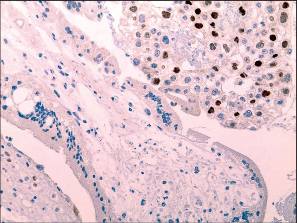 Absence of p57 staining In the villous cytotrophoblasts and villous stromal cells (×200).