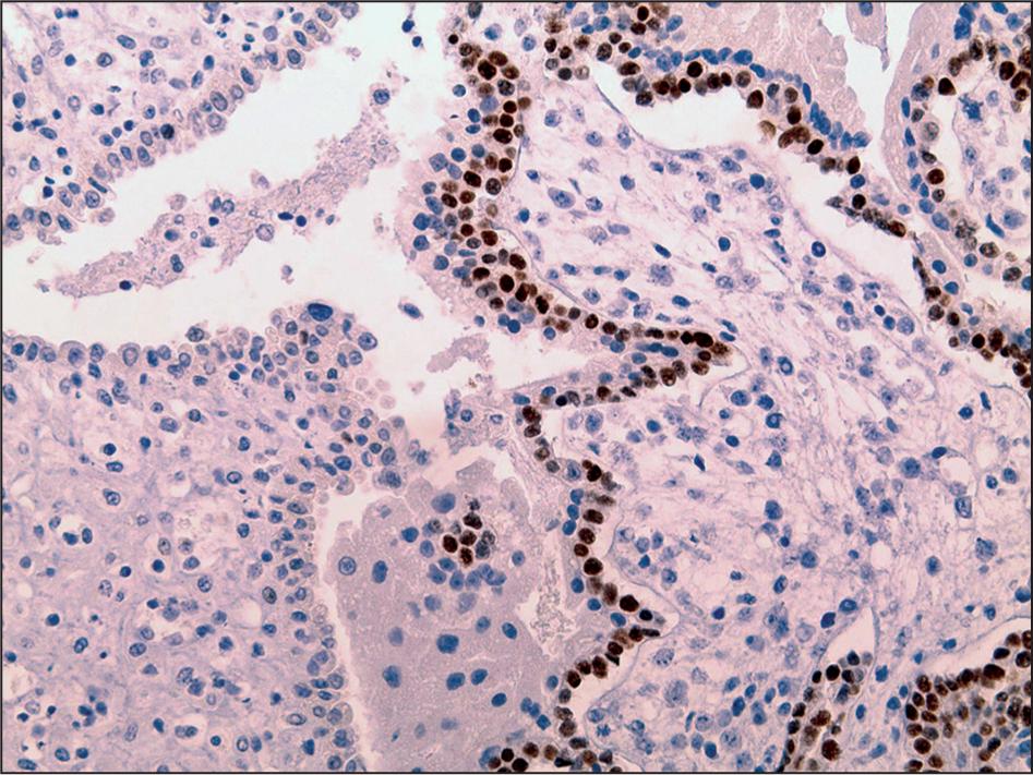 p63 staining in >50.0% of the villous cytotrophoblasts (×200).